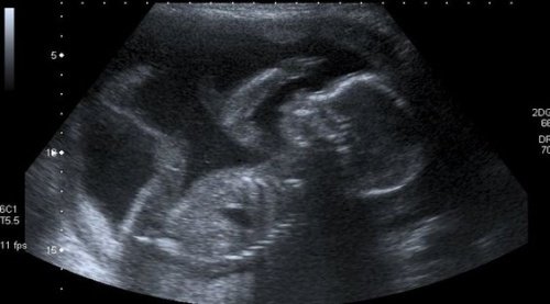 Baby ultralyd