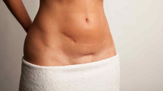 Keisersnitt er ikke den "enkle måten"