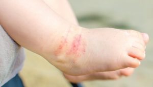 15 tips for å håndtere atopisk eksem hos barn