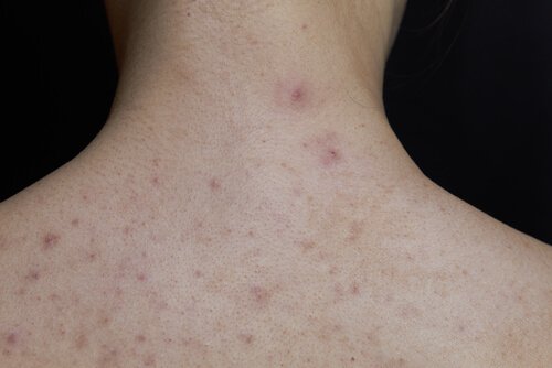 skarlagensfeber hos barn