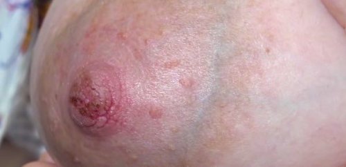 Forebygging og leging av såre, sprukne brystvorter