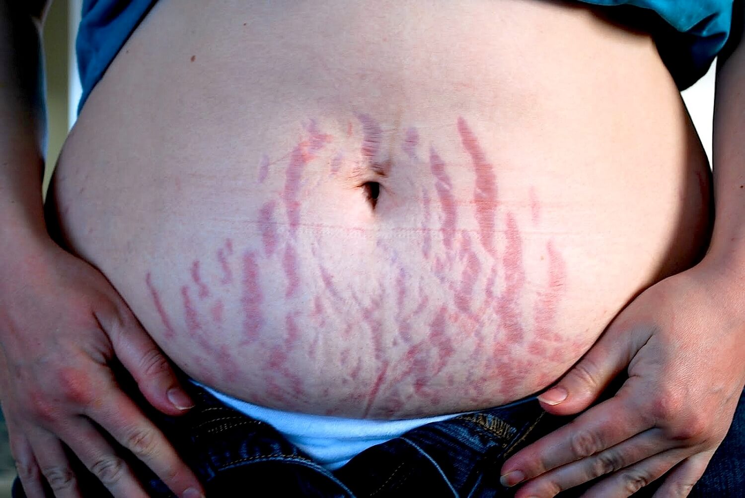 årsaker til strekkmerker under graviditeten