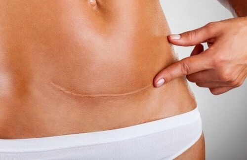 Behandling av et keisersnittarr etter barnefødsel