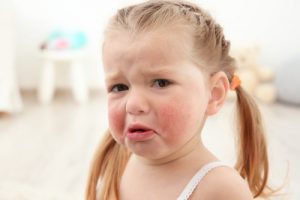 Vanlige matallergier; jente med allergi