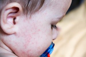 Vanlige matallergier som kan oppstå hos barn
