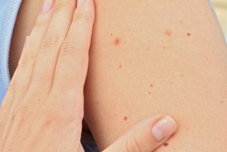 Alt du trenger å vite om føflekker hos barn
