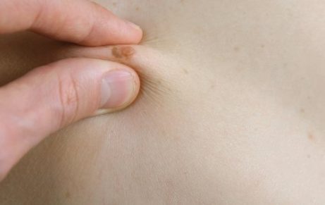 Alt du trenger å vite om føflekker hos barn