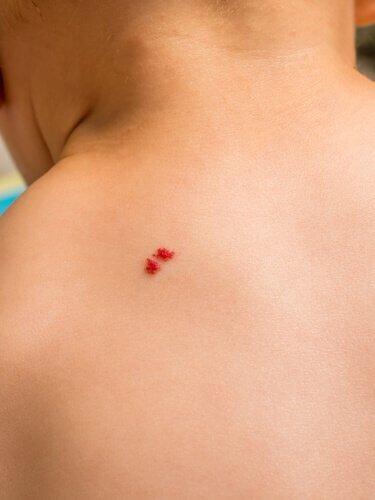 Hva skal jeg gjøre hvis barnet mitt har angiomer?