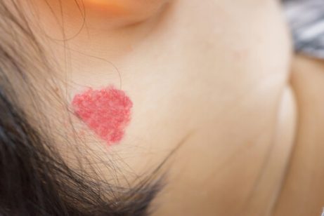 Hva skal jeg gjøre hvis barnet mitt har angiomer?