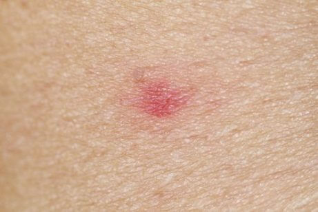 Merk av et veps på huden