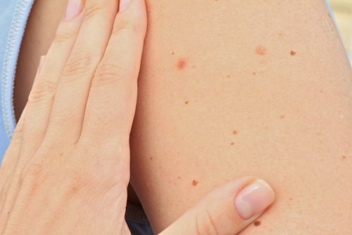 Forskjellige typer føflekker på en arm.