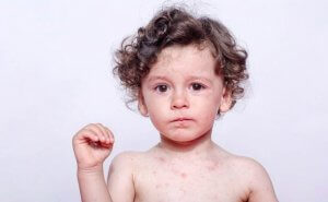 Allergier mot svette: Symptomer og behandling