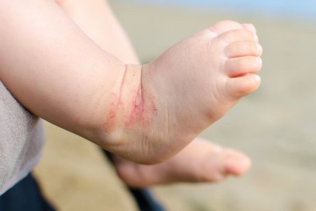 Eksem på en babys fot.