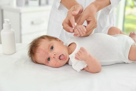 En baby med eksem i ansiktet ligger på et bord.