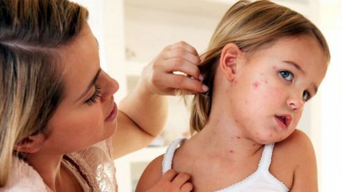 Meslinger hos barn: Symptomer, behandling og forebygging