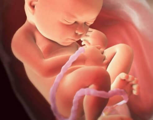 Navlesnoromslyng under graviditet og fødsel