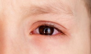 Subkonjunktival blødning på øyet, hva kommer det av?