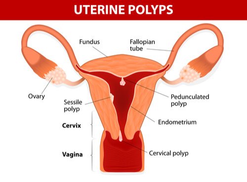Det finnes flere tester som kan påvise polypper i livmoren. 