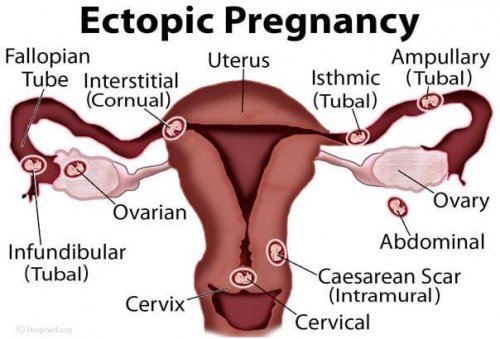 Ektopisk graviditet 2.