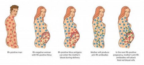 RhD-uforlikelighet under graviditet: Det du trenger å vite