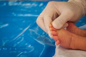 Pataus syndrom hos babyer: Årsaker og symptomer