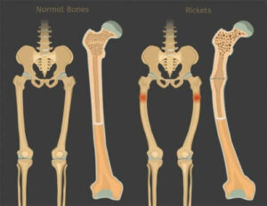 Rakitt: D-vitaminmangel hos barn