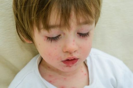 7 smittsomme sykdommer hos barn i skolealderen
