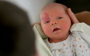 Sturge-Weber syndrom hos barn