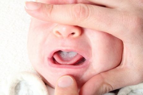 Oral trøske: Årsaker, symptomer og forebygging