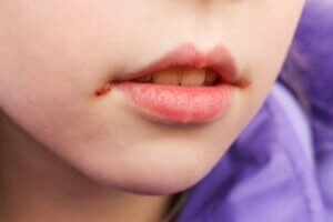 Når barn får munnsår: Årsaker og behandlinger