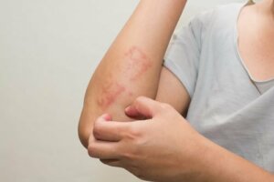 Psoriasis hos barn: Hva det er og hvordan det påvirker dem
