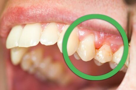 Gingivitt under graviditet