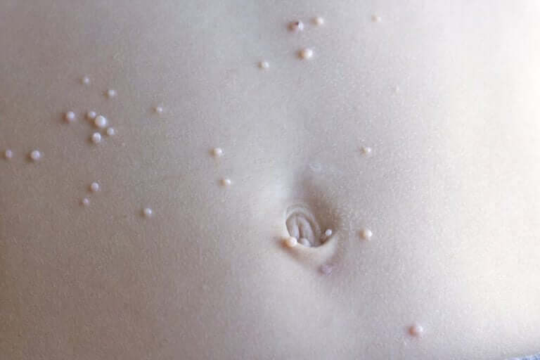 Hva gjør jeg hvis barnet mitt har mollusker?