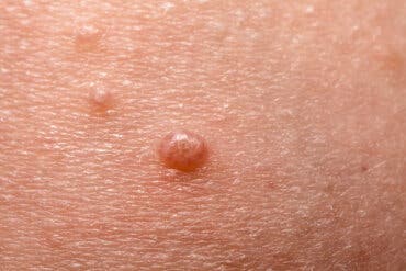 Hva gjør du hvis barnet ditt har molluscum contagiosum (MC)