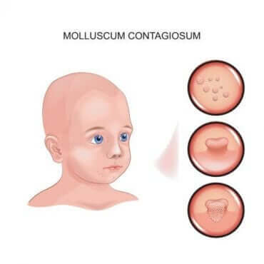 Hva gjør du hvis barnet ditt har Molluscum Contagiosum (MC)