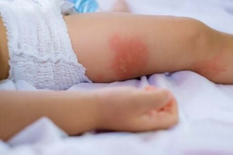 Vanlige matallergier hos babyer