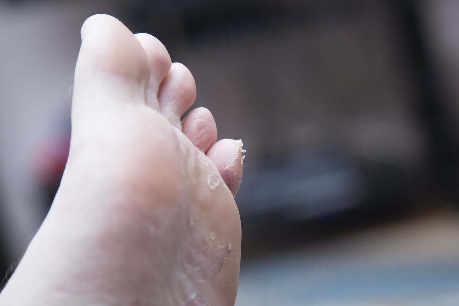 Juvenil plantar dermatose: Hva du bør vite