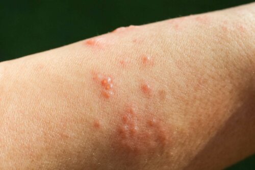 En arm med blemmer.