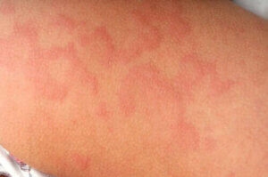 Erythema nodosum hos barn: symptomer, årsaker og behandling