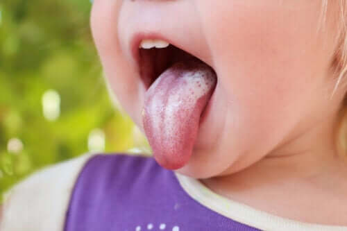 Oral candidiasis hos barn: symptomer, årsaker og behandling