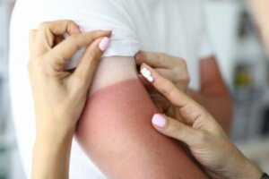 10 naturlige remedier for solbrenthet