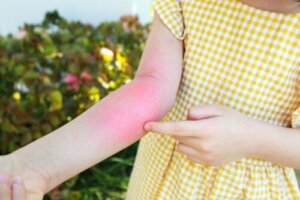 10 tips for behandling av kontakteksem hos barn