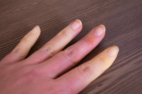 Hva er Raynauds fenomen?