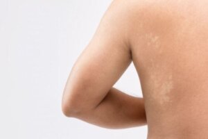 Pityriasis Versicolor hos ungdom: Hva du bør vite