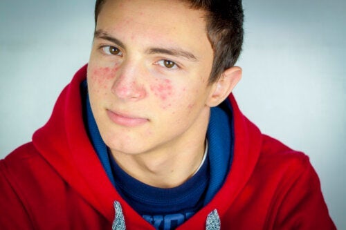 Akne hos tenåringer: Hva du bør, og ikke bør gjøre