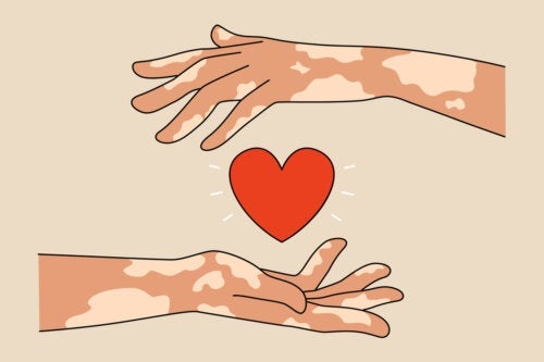 9 tips til foreldre til barn med vitiligo