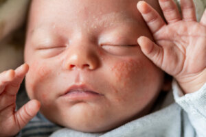 Babyen min har reaktiv hud