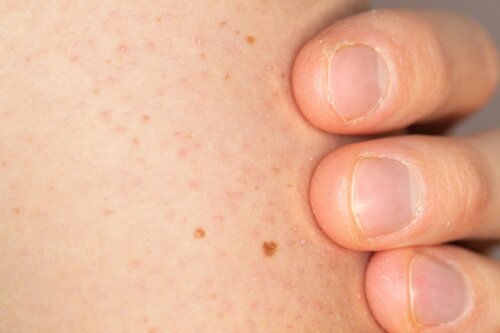 Hvordan ta vare på huden til barn med Keratosis Pilaris?