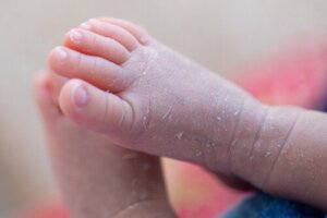 Årsakene til flassende hud hos babyer