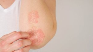 Psoriasis under graviditet: Hva du bør vite